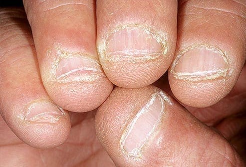 أظافرك تكشف معلومات عن حالتك الصحية