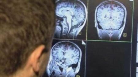 دراسة.. السكتة الدماغية قد تتسبب بوفاة 10 ملايين شخص بحلول 2050